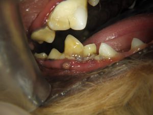 歯の変形が原因となった歯周病